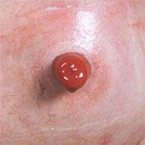 Healthy Peristomal Skin