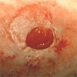 Irritated Peristomal Skin
