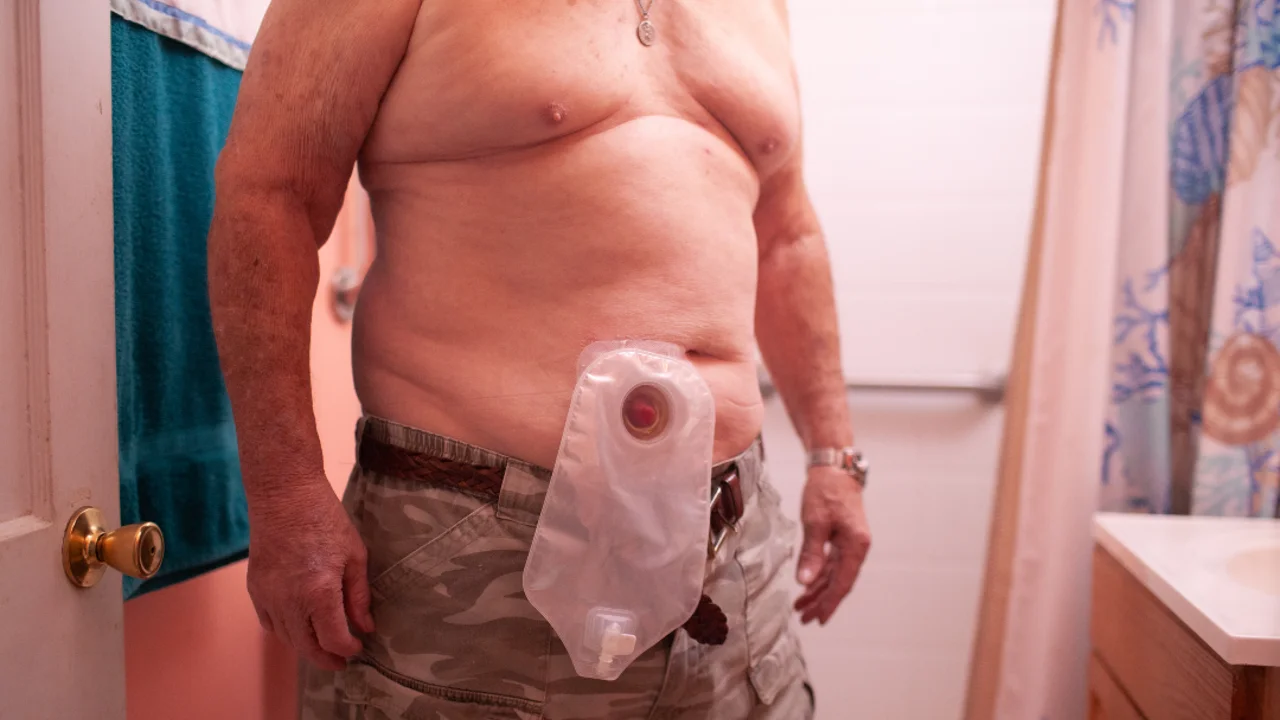 A woman was protecting the skin around her stoma with a secure pouch system
